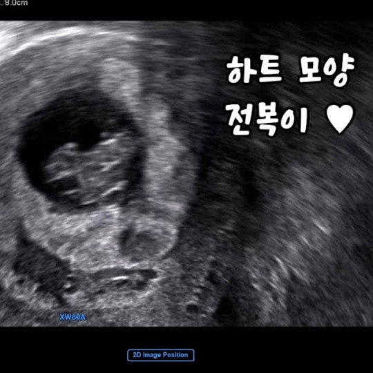 박수홍♥김다예, 결혼 3년 만 임신…