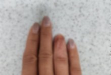 '고의로 손가락 훼손' 산업재해 위장한 외국인·브로커 적발