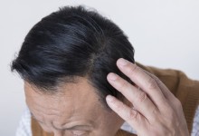 두피에 붙이는 ‘탈모 패치’ 나왔다…“모발세포 23% 증식”