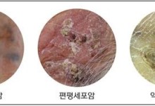 "여름 아닌 겨울에도" 장시간 자외선 노출에 '이 거' 발생 주의