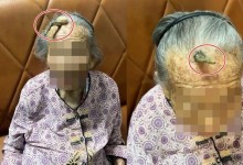 “장수의 상징”…107세 여성 이마에 난 ‘유니콘 뿔’의 정체