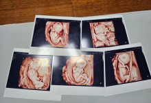 엄마 지킬 다섯 쌍둥이…‘팡팡레이저’ 무사 출생 완료!