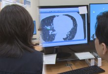 여성 폐암 90%가 비흡연…국가 검진에서 제외