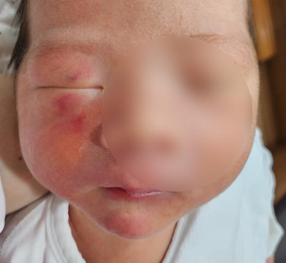 "3시간 전 멀쩡했는데"...생후 4일 신생아 상처 논란